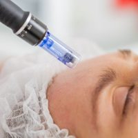 dermapen alcala de henares